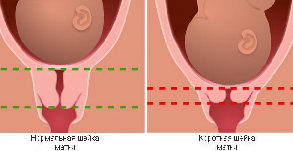 Шейка матки во время беременности