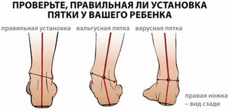 Профилактика детского плоскостопия и его лечение