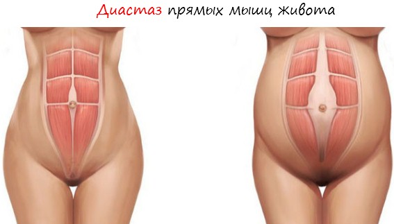 Диастаз - растяжки при беременности и после