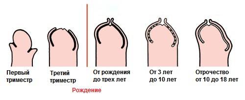 Физиологический фимоз у мальчиков