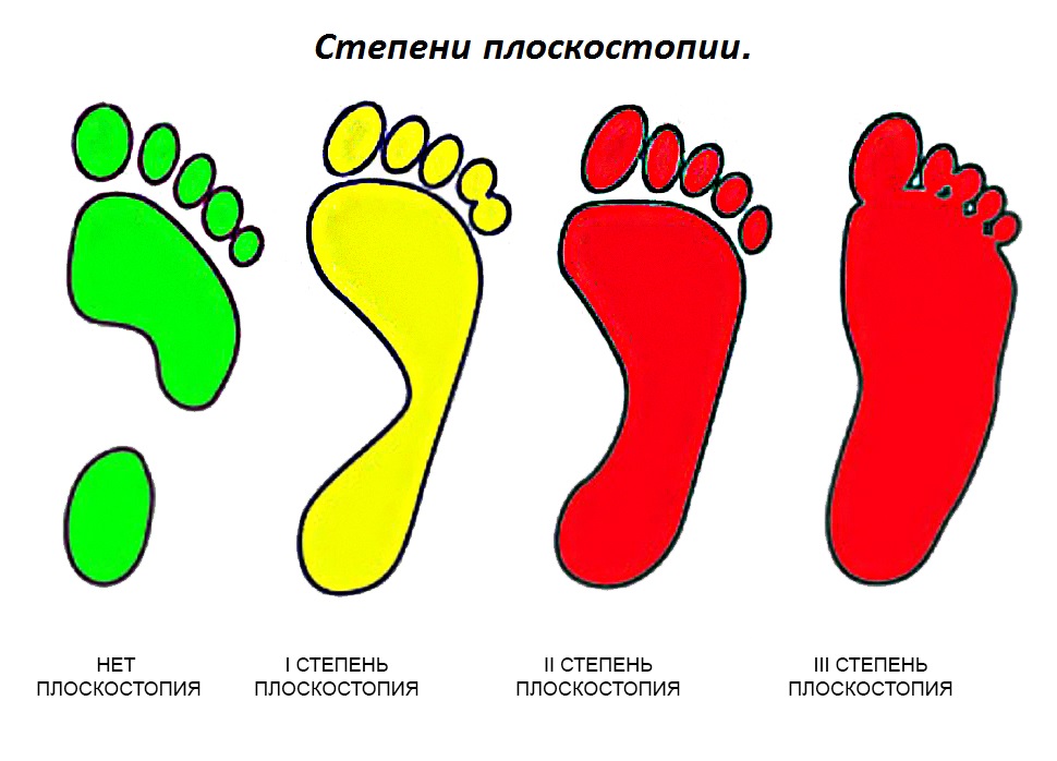 Профилактика детского плоскостопия и его лечение